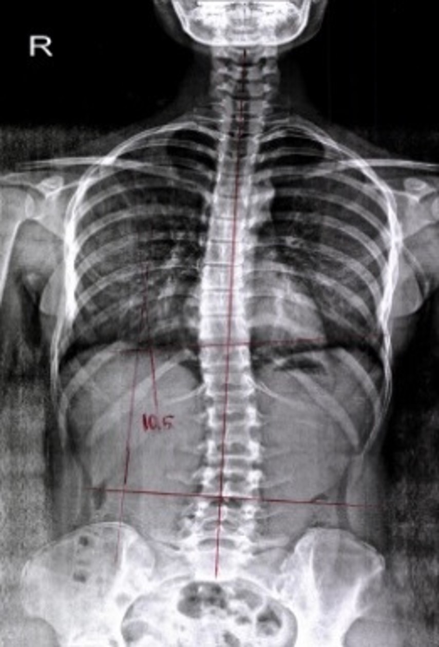 치료 후 척추 엑스레이