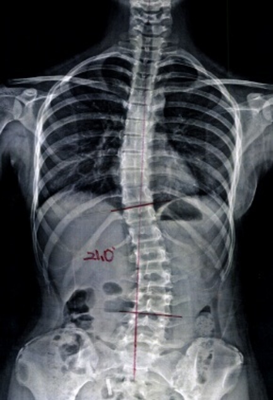 치료 전 척추 엑스레이